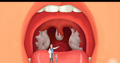 Diphtheria