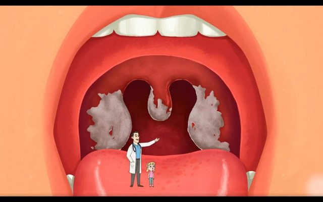 Diphtheria