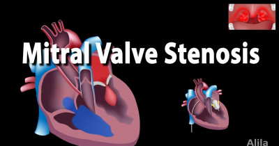 Mitral stenosis