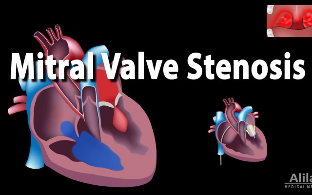 Mitral stenosis