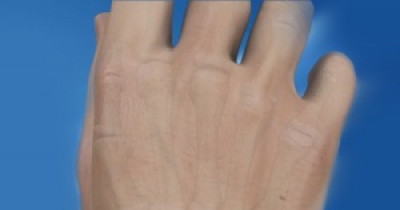 Malunion fracture 