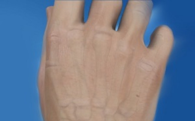 Malunion fracture 