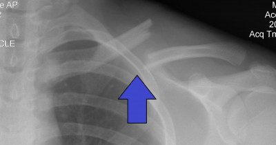 Clavicle bone fracture