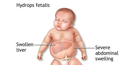 Hydrops fetalis