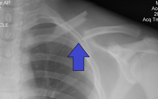 Clavicle bone fracture