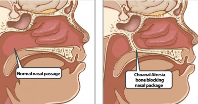 Choanal atresia 