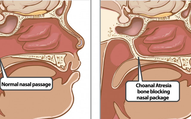 Choanal atresia 