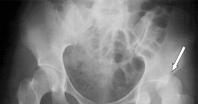 Posterior dislocation of hip joint 