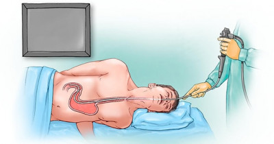 Upper gastrointestinal bleeding 