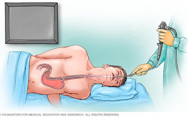 Upper gastrointestinal bleeding 