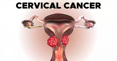 Cervical cancer 