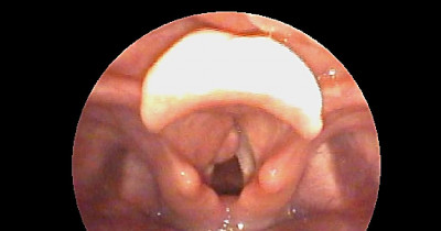 Laryngocele