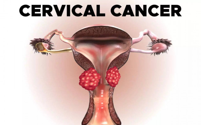 Cervical cancer 