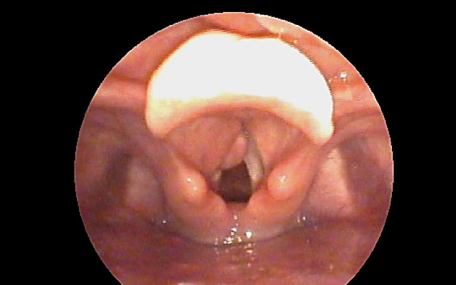 Laryngocele
