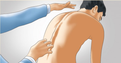 Scoliosis