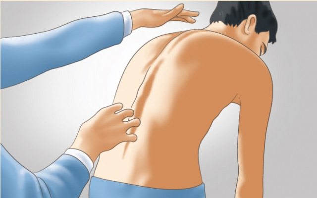 Scoliosis