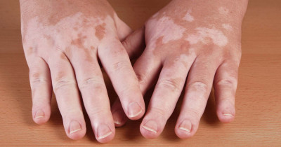 Vitiligo 