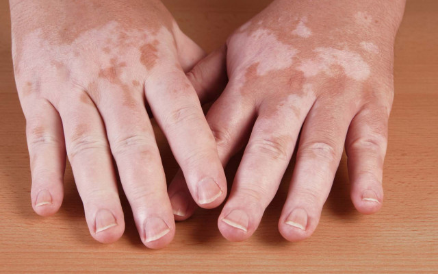 Vitiligo 