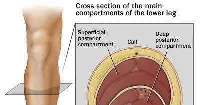 compartment syndrome