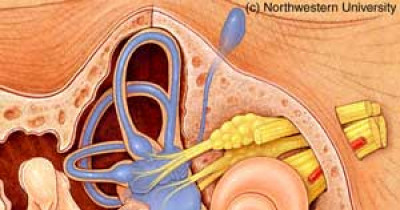 Meniere's disease 