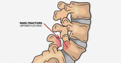 Spondylolisthesis