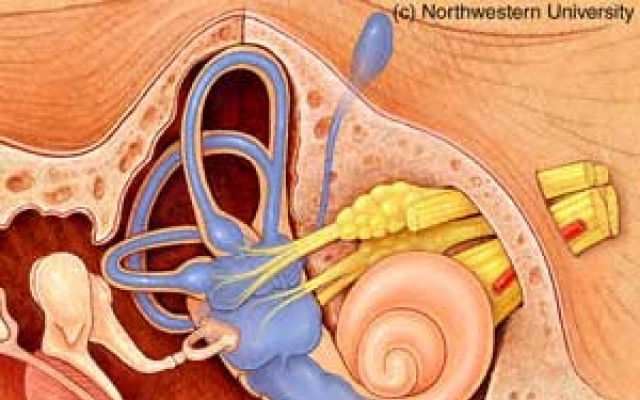 Meniere's disease 