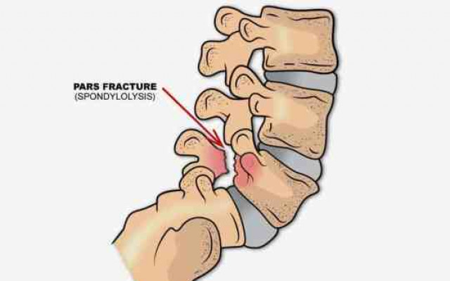 Spondylolisthesis